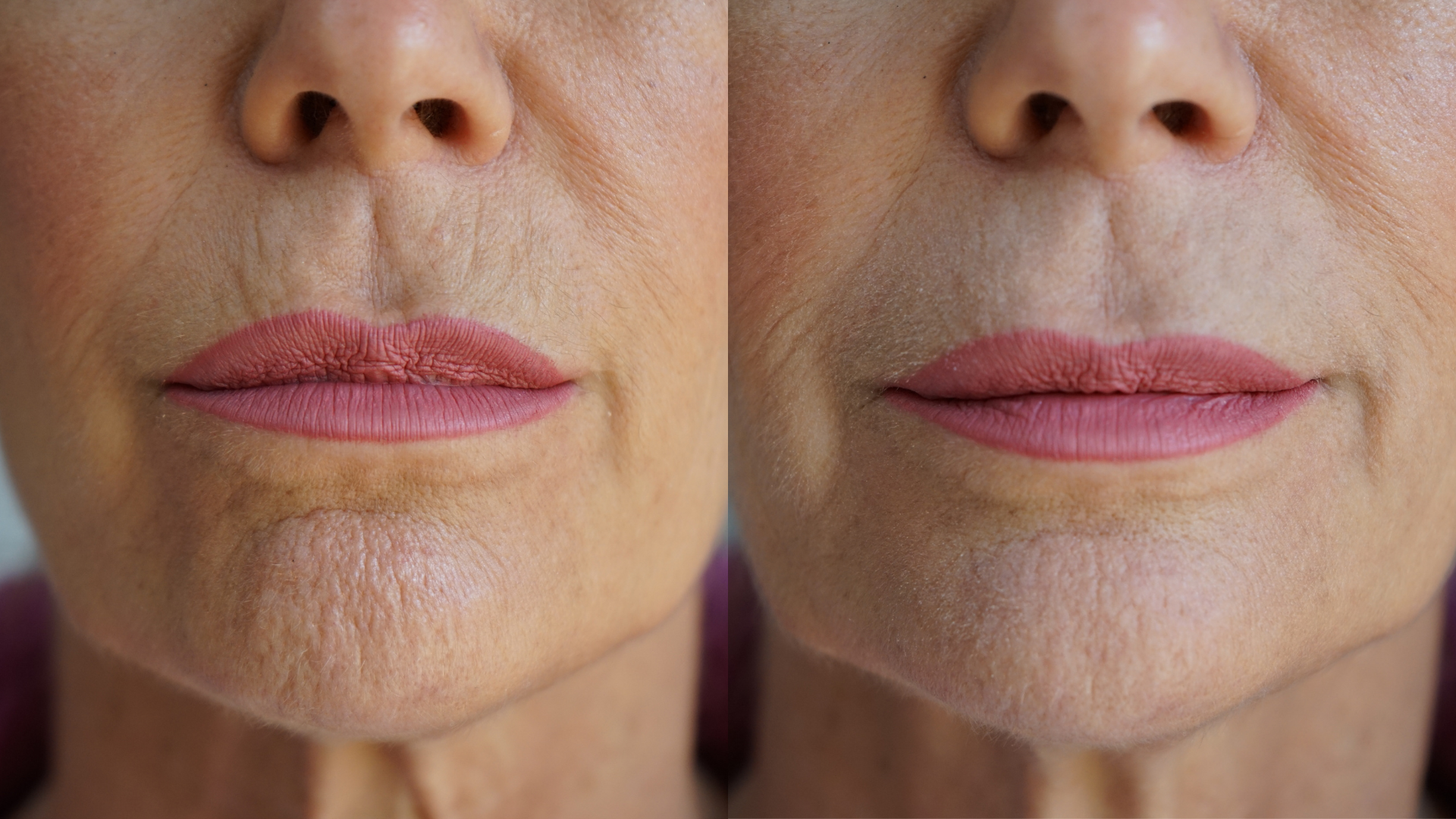 Ageless Lip & Line Filler – Plump Lips & Smooth Fine Lines